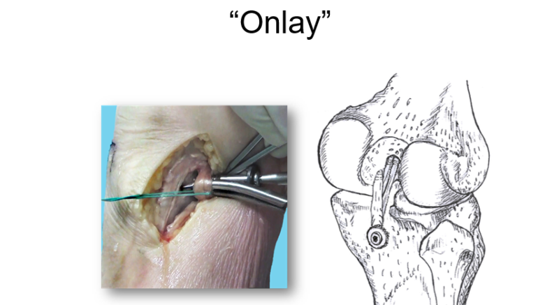 Onlay: técnica brasileira de reconstrução de LCP