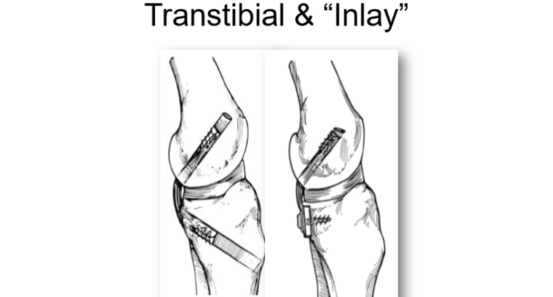 Transtibial e inlay