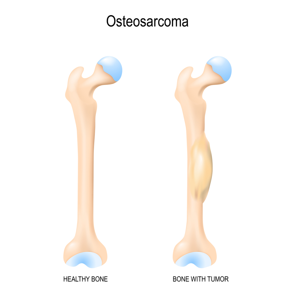 À esquerda, um fêmur saudável. À direita, um fêmur com osteossarcoma.