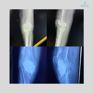 Revisão de prótese com tecnologia Hinge.  Paciente estava sem andar há três anos. Depois dessa cirurgia, sua história vai mudar.